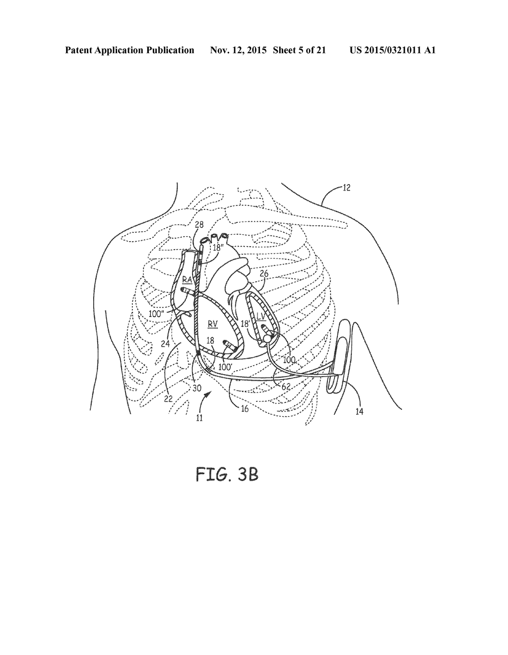 TRIGGERED PACING SYSTEM - diagram, schematic, and image 06