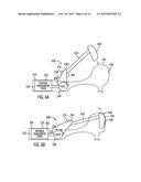 SHOE TREATMENT diagram and image