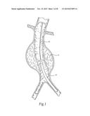 Surgical Fastener Assembly for Attaching a Prosthesis diagram and image