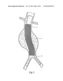 Surgical Fastener Assembly for Attaching a Prosthesis diagram and image