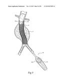 Surgical Fastener Assembly for Attaching a Prosthesis diagram and image