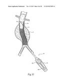 Surgical Fastener Assembly for Attaching a Prosthesis diagram and image
