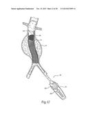 Surgical Fastener Assembly for Attaching a Prosthesis diagram and image