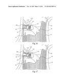 Surgical Fastener Assembly for Attaching a Prosthesis diagram and image