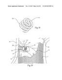 Surgical Fastener Assembly for Attaching a Prosthesis diagram and image