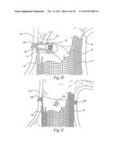 Surgical Fastener Assembly for Attaching a Prosthesis diagram and image