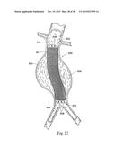 Surgical Fastener Assembly for Attaching a Prosthesis diagram and image