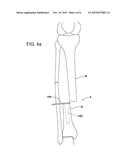 TEMPORARY FRACTURE STABILIZATION DEVICE diagram and image