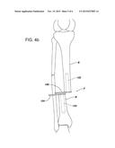 TEMPORARY FRACTURE STABILIZATION DEVICE diagram and image