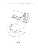 IMPLANT POSITIONING DEVICE FOR AN ORTHODONTIC BRACE diagram and image