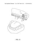 IMPLANT POSITIONING DEVICE FOR AN ORTHODONTIC BRACE diagram and image