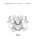 IMPLANTS, TOOLS, AND METHODS FOR TREATMENT OF PELVIC CONDITIONS diagram and image