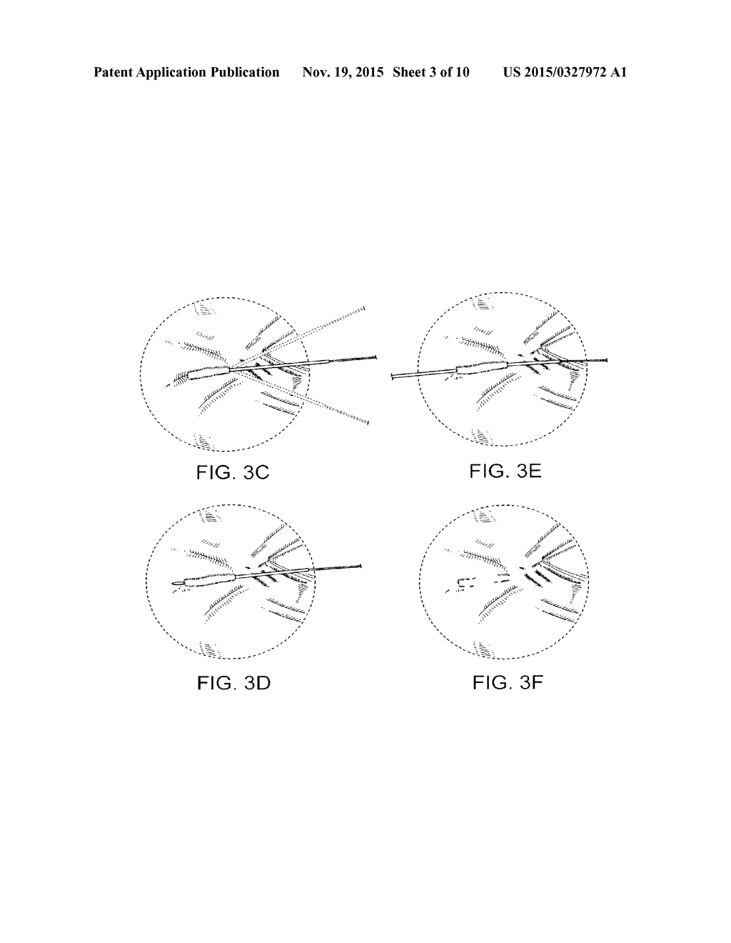 SOFT TISSUE AUGMENTATION THREADS AND METHODS OF USE THEREOF - diagram, schematic, and image 04