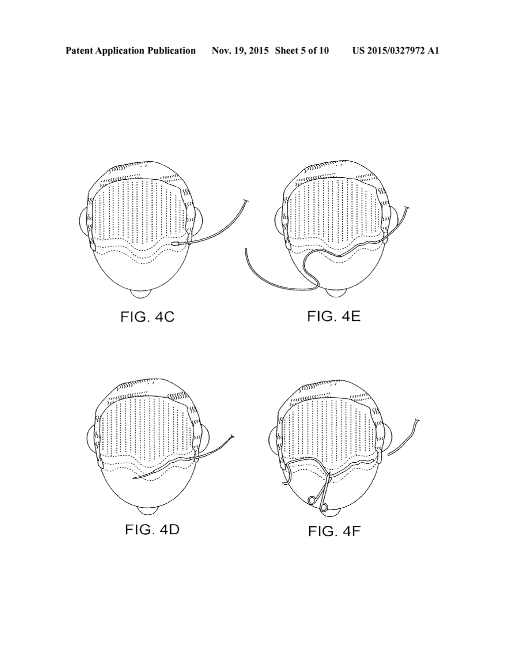 SOFT TISSUE AUGMENTATION THREADS AND METHODS OF USE THEREOF - diagram, schematic, and image 06