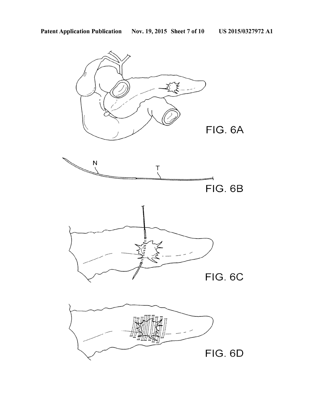 SOFT TISSUE AUGMENTATION THREADS AND METHODS OF USE THEREOF - diagram, schematic, and image 08