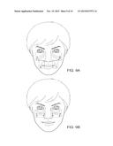 SOFT TISSUE AUGMENTATION THREADS AND METHODS OF USE THEREOF diagram and image