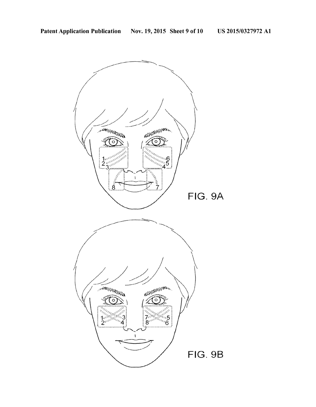 SOFT TISSUE AUGMENTATION THREADS AND METHODS OF USE THEREOF - diagram, schematic, and image 10