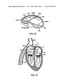 PROSTHETIC HEART VALVE DEVICES AND ASSOCIATED SYSTEMS AND METHODS diagram and image