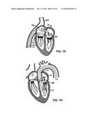PROSTHETIC HEART VALVE DEVICES AND ASSOCIATED SYSTEMS AND METHODS diagram and image