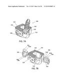 Standalone Interbody Implants diagram and image