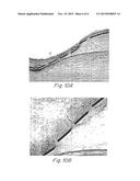 COMPLIANT IMPLANTABLE MEDICAL DEVICES AND METHODS OF MAKING SAME diagram and image