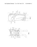 ORTHOPEDIC DEVICE FOR TREATING COMPLICATIONS OF THE HIP diagram and image