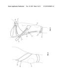 ORTHOPEDIC DEVICE FOR TREATING COMPLICATIONS OF THE HIP diagram and image