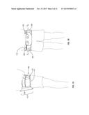 ORTHOPEDIC DEVICE FOR TREATING COMPLICATIONS OF THE HIP diagram and image