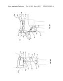 ORTHOPEDIC DEVICE FOR TREATING COMPLICATIONS OF THE HIP diagram and image