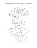 ORTHOPEDIC DEVICE FOR TREATING COMPLICATIONS OF THE HIP diagram and image