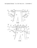 ORTHOPEDIC DEVICE FOR TREATING COMPLICATIONS OF THE HIP diagram and image