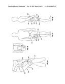 ORTHOPEDIC DEVICE FOR TREATING COMPLICATIONS OF THE HIP diagram and image