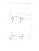 ORTHOPEDIC DEVICE FOR TREATING COMPLICATIONS OF THE HIP diagram and image