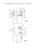 ORTHOPEDIC DEVICE FOR TREATING COMPLICATIONS OF THE HIP diagram and image