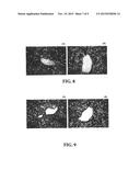 NASAL VACCINE AGAINST THE DEVELOPMENT OF ATHEROSCLEROSIS DISEASE AND FATTY     LIVER diagram and image