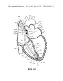 SYSTEM AND METHOD FOR RATE MODULATED CARDIAC THERAPY UTILIZING A     TEMPERATURE SENOR diagram and image