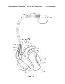 SYSTEM AND METHOD FOR RATE MODULATED CARDIAC THERAPY UTILIZING A     TEMPERATURE SENOR diagram and image