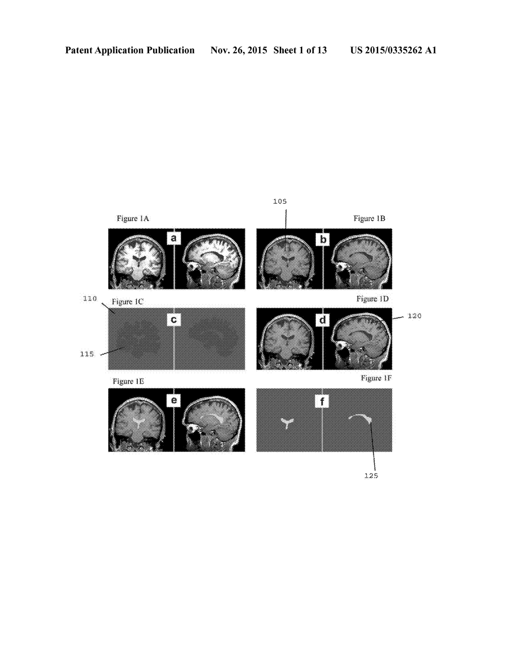 SYSTEM, METHOD AND COMPUTER-ACCESSIBLE MEDIUM FOR THE PROBABILISTIC     DETERMINATION OF NORMAL PRESSURE HYDROCEPHALUS - diagram, schematic, and image 02