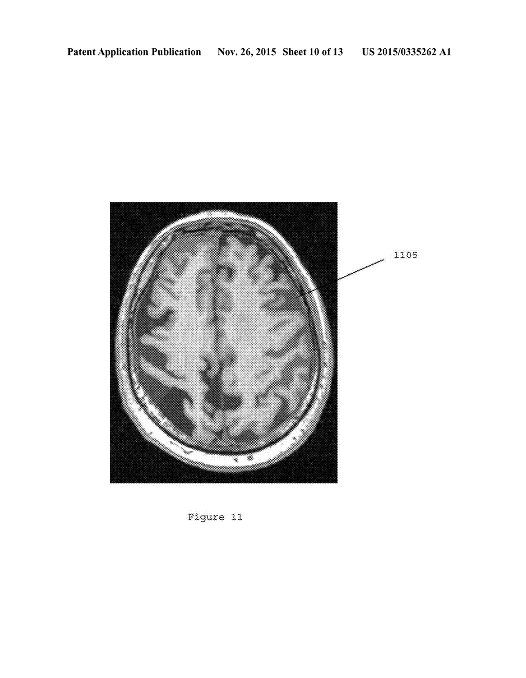 SYSTEM, METHOD AND COMPUTER-ACCESSIBLE MEDIUM FOR THE PROBABILISTIC     DETERMINATION OF NORMAL PRESSURE HYDROCEPHALUS - diagram, schematic, and image 11