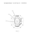 SYSTEM, METHOD AND COMPUTER-ACCESSIBLE MEDIUM FOR THE PROBABILISTIC     DETERMINATION OF NORMAL PRESSURE HYDROCEPHALUS diagram and image