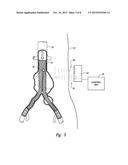 STENT GRAFT MONITORING ASSEMBLY AND METHOD OF USE THEREOF diagram and image