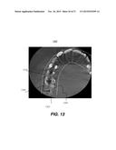METHOD FOR TEETH SEGMENTATION AND ALIGNMENT DETECTION IN CBCT VOLUME diagram and image