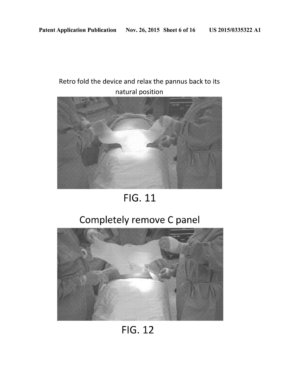 RETRACTOR/STABILIZER FOR EXCESSIVE AND/OR REDUNDANT TISSUE AND METHOD OF     USE - diagram, schematic, and image 07