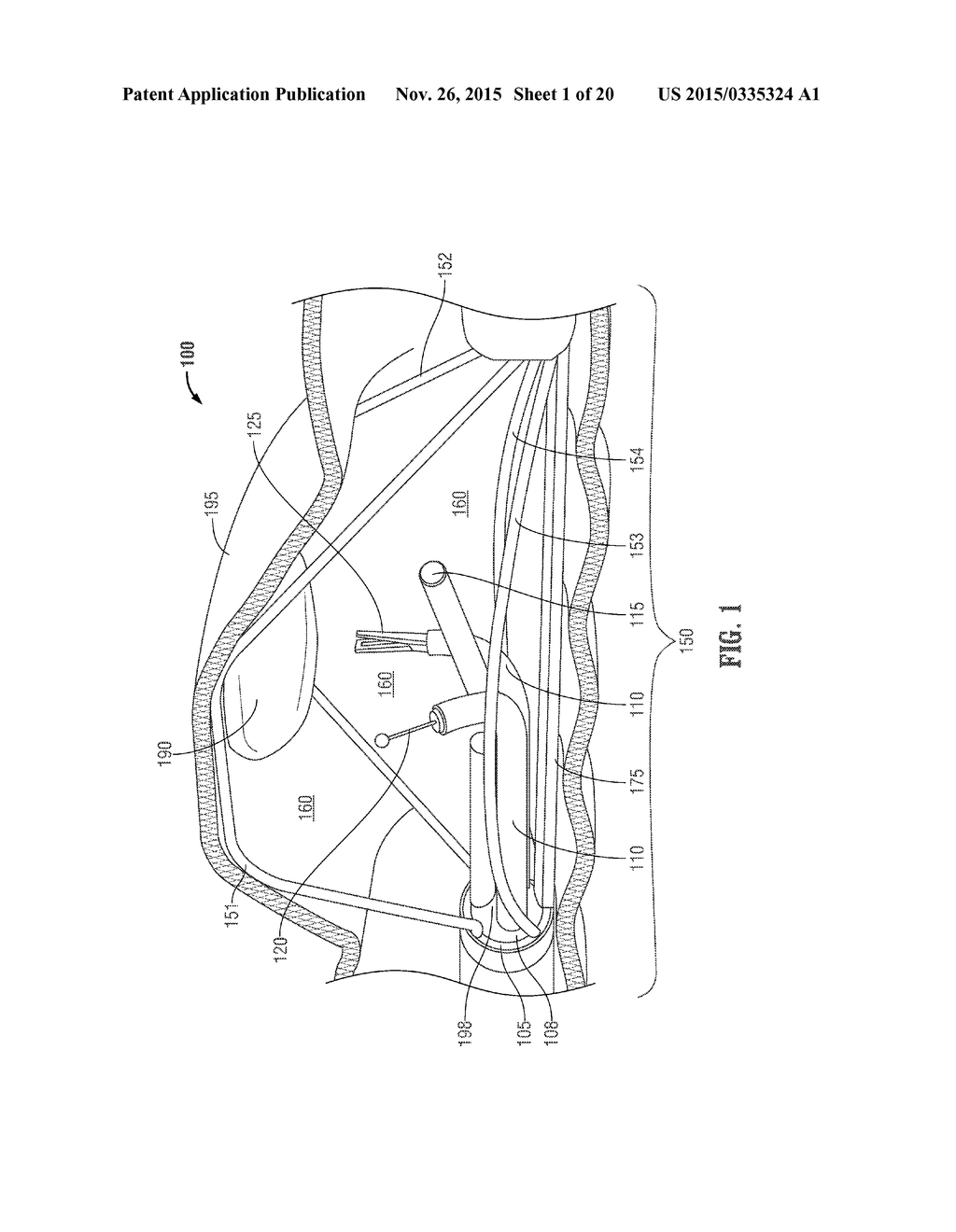 ENDOLUMINAL DEVICE WITH RETRACTOR SYSTEM - diagram, schematic, and image 02