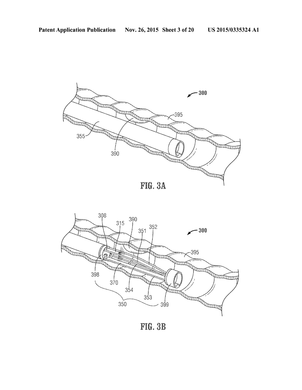 ENDOLUMINAL DEVICE WITH RETRACTOR SYSTEM - diagram, schematic, and image 04