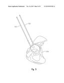 ACETABULAR DRILL PIN diagram and image