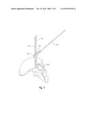 ACETABULAR DRILL PIN diagram and image