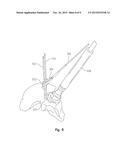 ACETABULAR DRILL PIN diagram and image