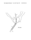 TISSUE RESECTION AND TREATMENT WITH SHEDDING PULSES diagram and image