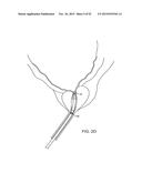 TISSUE RESECTION AND TREATMENT WITH SHEDDING PULSES diagram and image